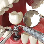 Dental implant