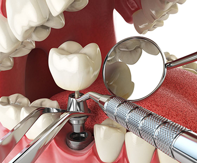 Dental implant